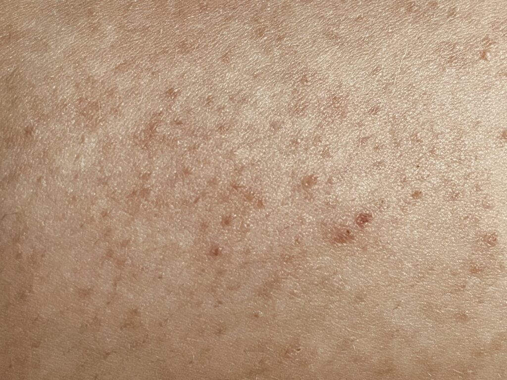 keratosis pilaris itselleni.fi