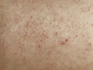 keratosis pilaris itselleni.fi