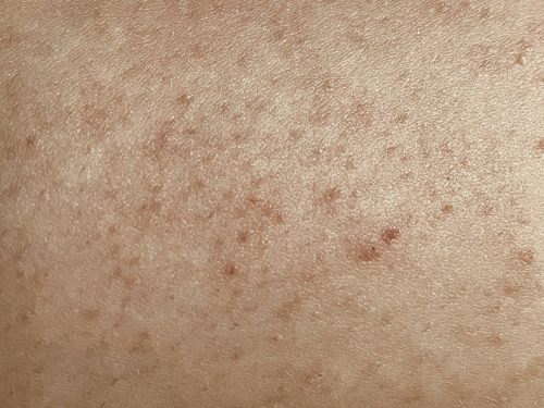 keratosis pilaris itselleni.fi